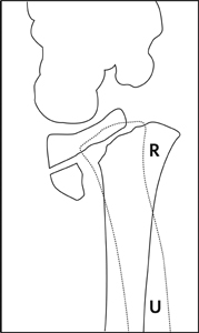 Fracture_Distal radius physeal_Figure 3_1370609-Salter-Harris2_lateral_drawing.jpg